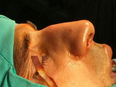 Nose Bone Surgery